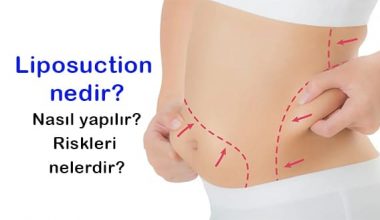 Yağ aldırma ameliyatı (Liposuction) nasıl yapılır ?