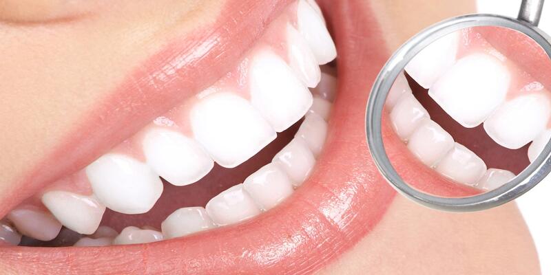 Diş beyazlatma nedir ?