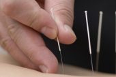 Hangi hastalıklar Akupunktur yöntemi ile tedavi edilebilir?