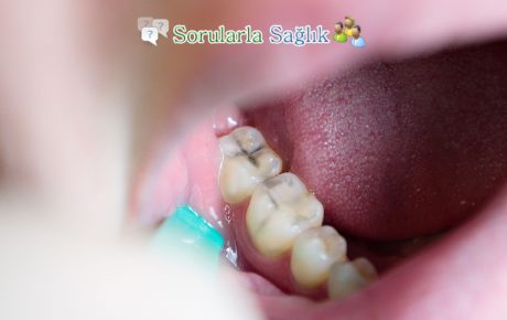 Diş Çürükleri İçin Evde Tedavi Yolları Nelerdir?