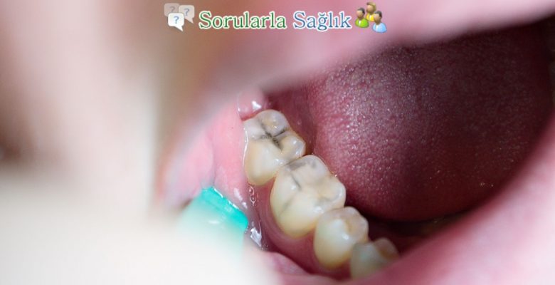 Diş Çürükleri İçin Evde Tedavi Yolları Nelerdir?